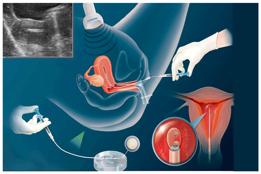 Best IUI Treatment Center in Delhi