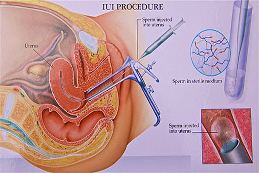 Why IUI Procedure done