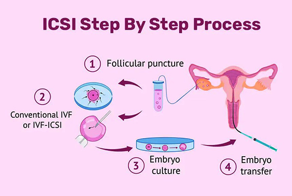 Preparing for ICSI Treatment